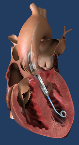 Impella ECP, the world's smallest heart pump, is placed percutaneously into the heart's left ventricle. (Graphic: Business Wire)