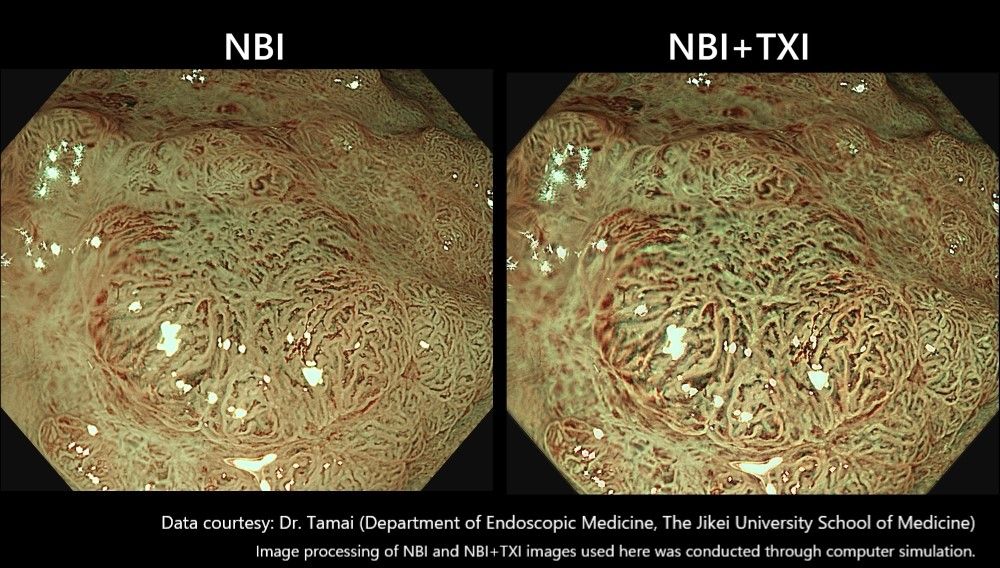 Left: NBI mode image  Right: NBI+TXI mode image