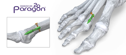 Phantom® Metatarsal Shortening System (Graphic: Business Wire)