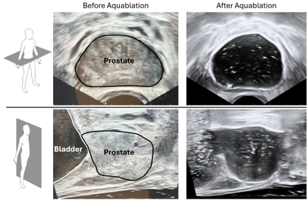 Ultrasound-guided, transurethral robotic waterjet resection of the prostate designed to remove cancer, at-risk tissue, and any obstructive tissue resulting in >95% of the gland being resected leaving only the outer prostatic capsule intact.