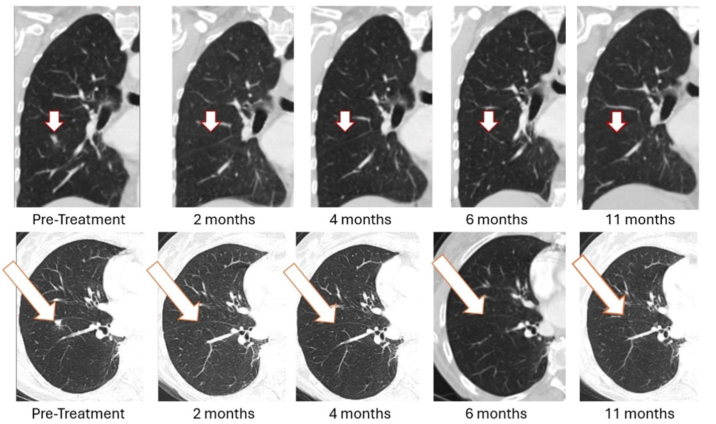 As previously reported in January 2026, treatment with Bria-OTS monotherapy resulted in 100% resolution of tumor in the right lung of the metastatic breast cancer (MBC) patient following 2 months of therapy and confirmed at 4, 6, and 11 months of therapy1 (axial and coronal views)