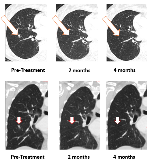 Treatment with Bria-OTS monotherapy resulted in 100% resolution of tumor in the lung of the metastatic breast cancer (MBC) patient following 2 months of therapy and confirmed at 4 months of therapy  (axial and coronal views)