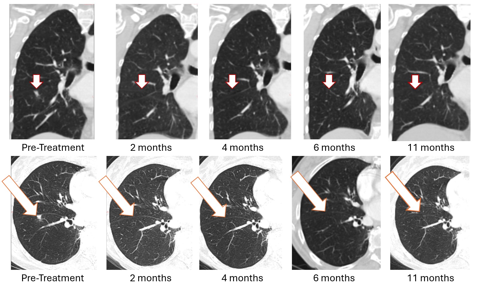 BriaCell Reports Sustained Complete Resolution of Lung Metastasis in Bria-OTS™ Patient