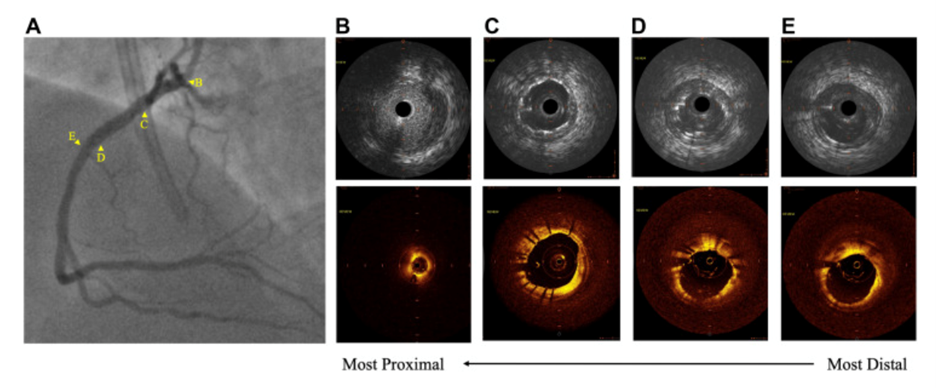 Figure 2: After percutaneous coronary intervention