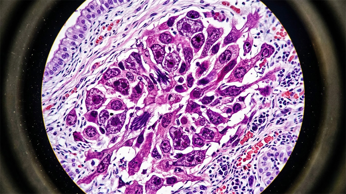 Microscopic view of cancer cells on a pathology slide, representing oncology research and cancer drug development in biotech.