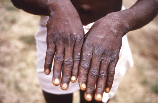 FILE - This 1997 image provided by the CDC during an investigation into an outbreak of monkeypox, which took place in the Democratic Republic of the Congo (DRC), formerly Zaire, and depicts the dorsal surfaces of the hands of a monkeypox case patient, who was displaying the appearance of the characteristic rash during its recuperative stage. The World Health Organization is convening its emergency committee  on Thursday, July 21, 2022 to consider for the second time within weeks whether the expanding outbreak of monkeypox should be declared a global crisis.  (CDC via AP, File)